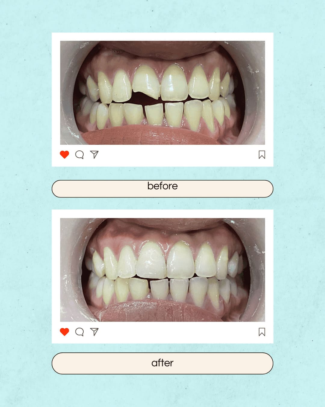 Composite (White) Fillings