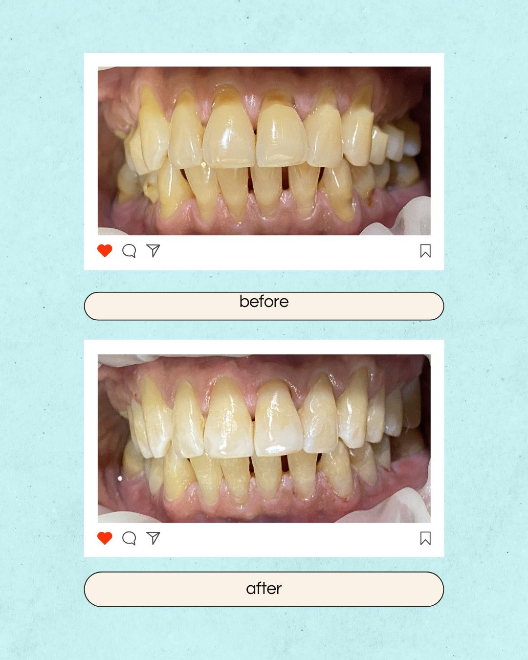 Composite (White) Fillings
